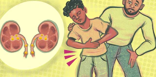An Alarming Surge in Kidney Stones Among Children