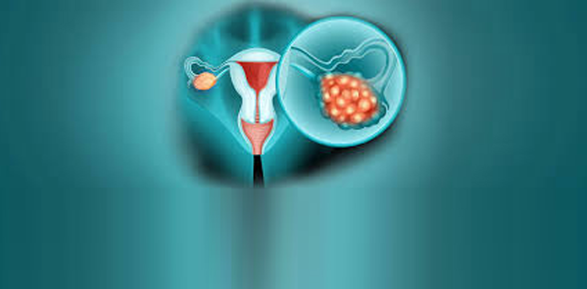 Recognizing the Early Signs of Ovarian Cancer