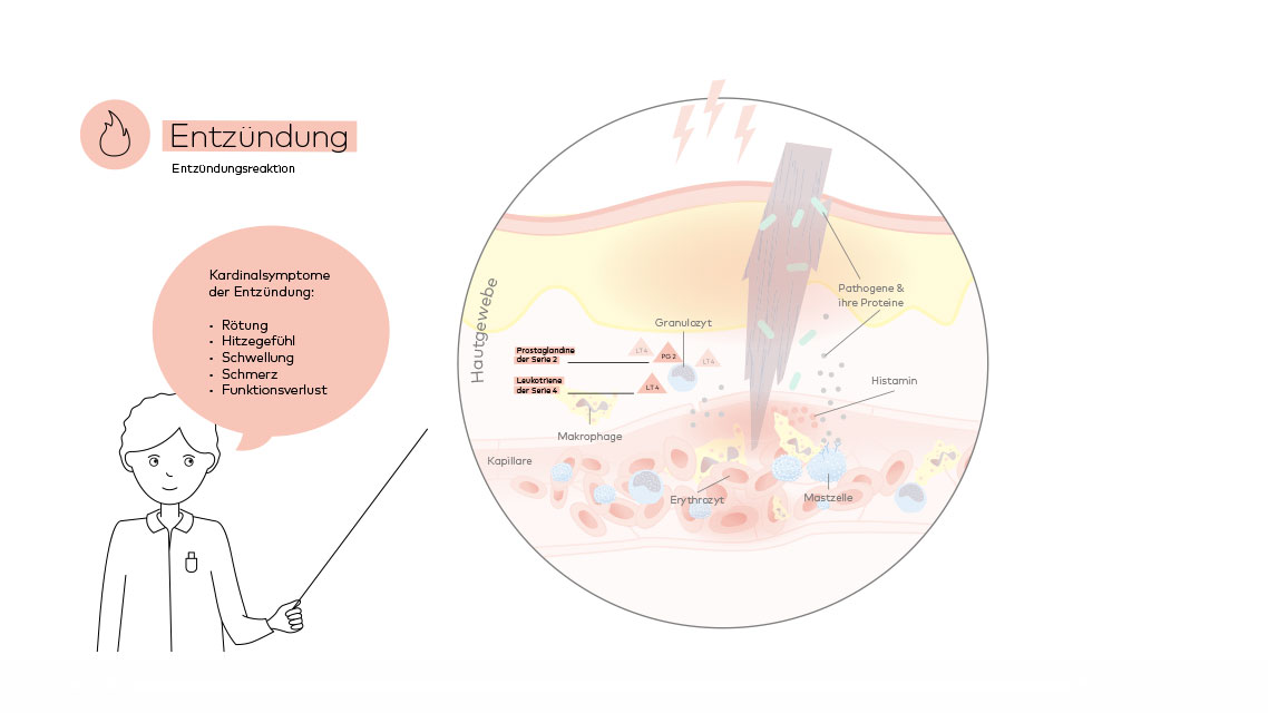 Darstellung einer Entzündung