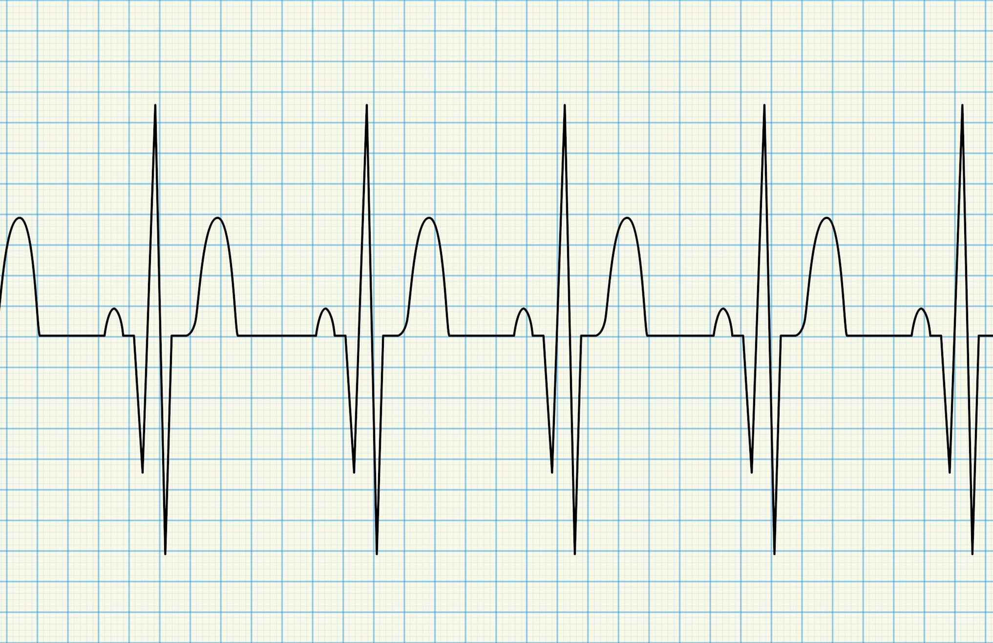 EKG