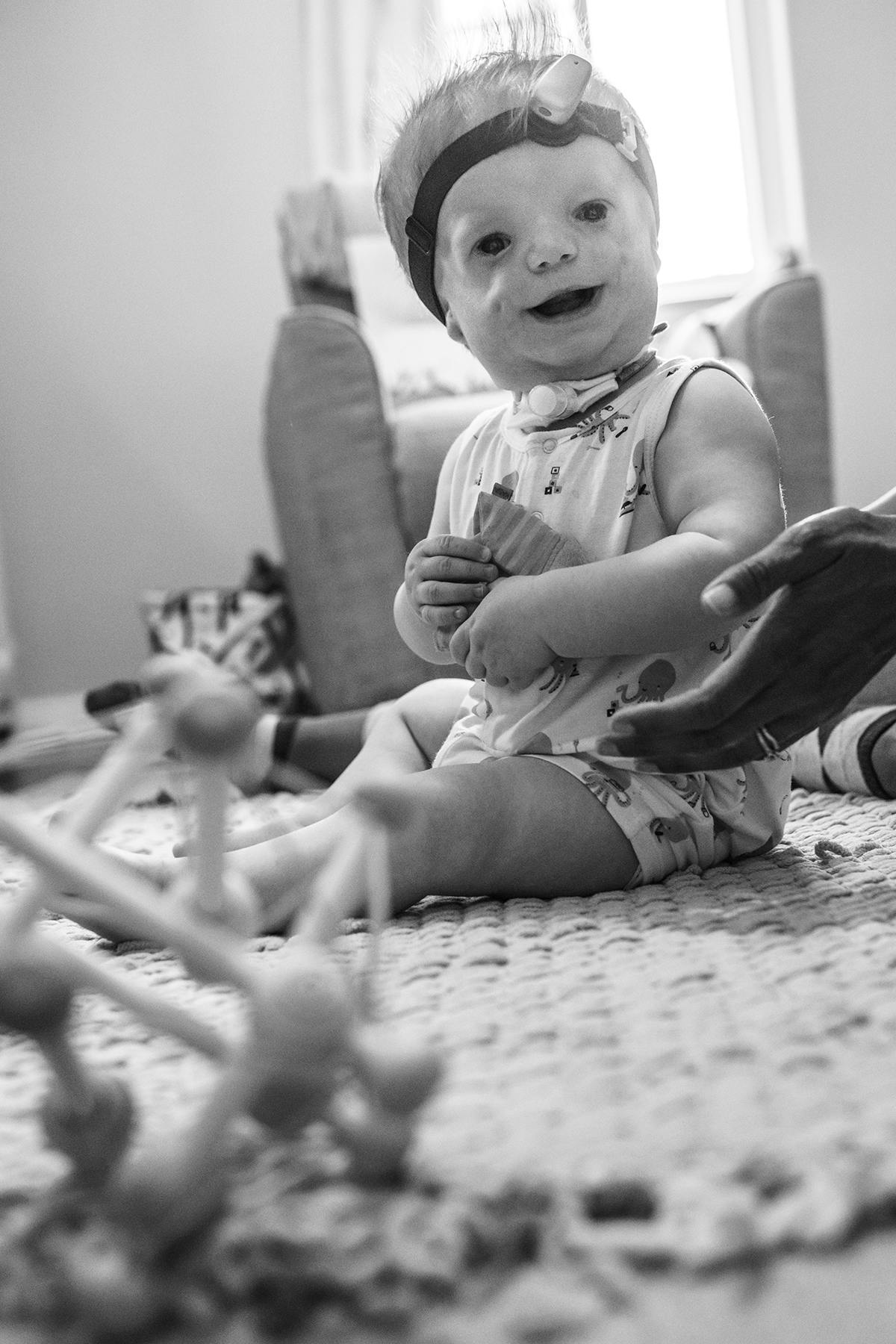 Photograph of young child with Treacher Collins syndrome by documentary photographer Kirsten Lewis