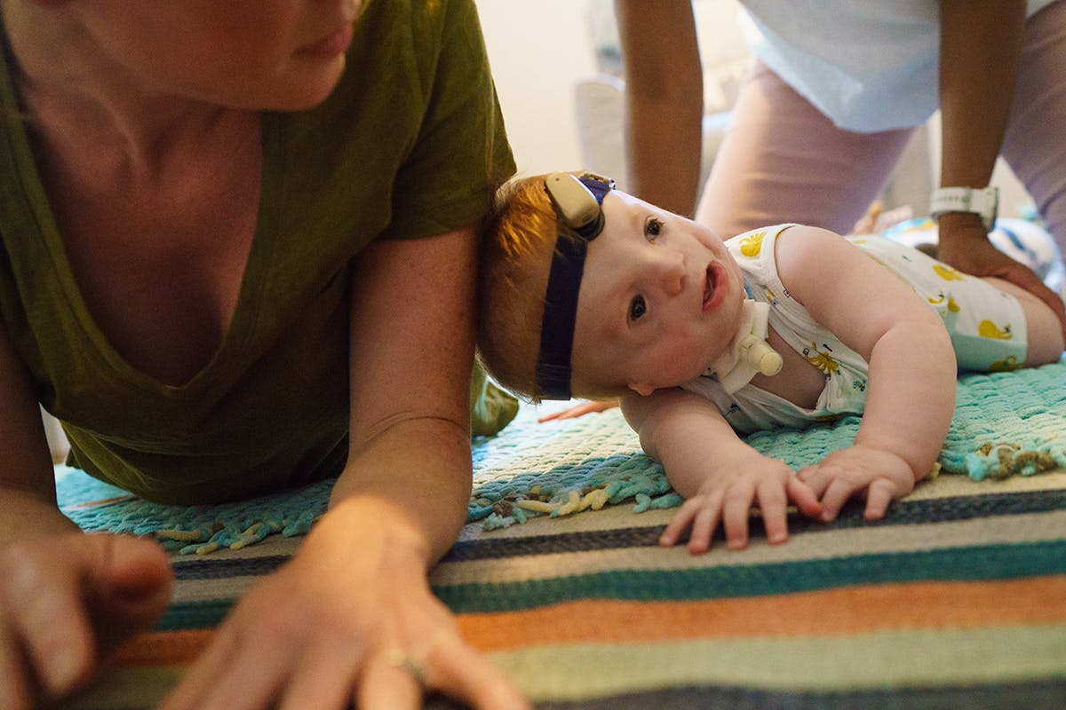 Photograph of young child with Treacher Collins syndrome and mother by documentary photographer Kirsten Lewis