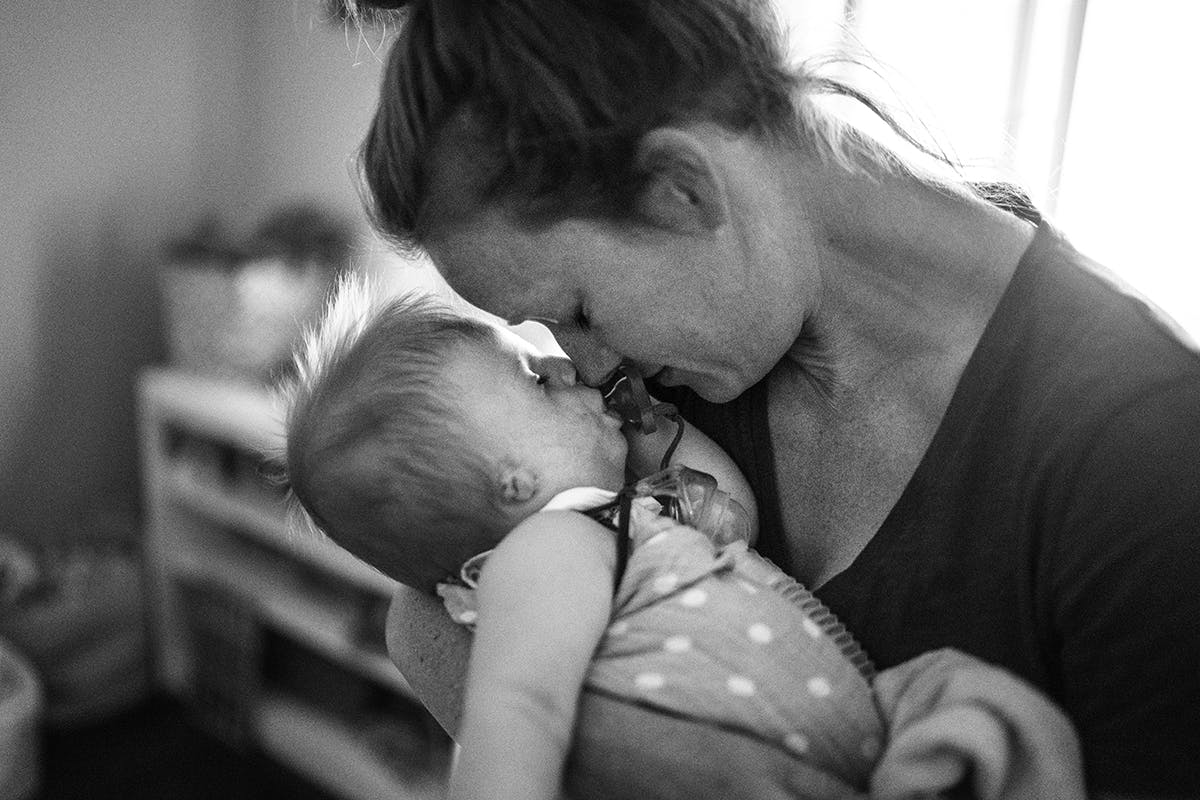 Photograph of young child with Treacher Collins syndrome and mother by documentary photographer Kirsten Lewis