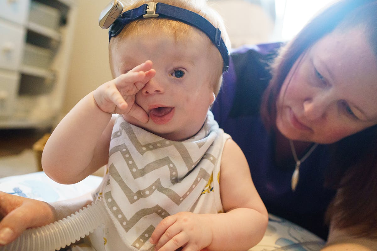 Photograph of young child with Treacher Collins syndrome by documentary photographer Kirsten Lewis