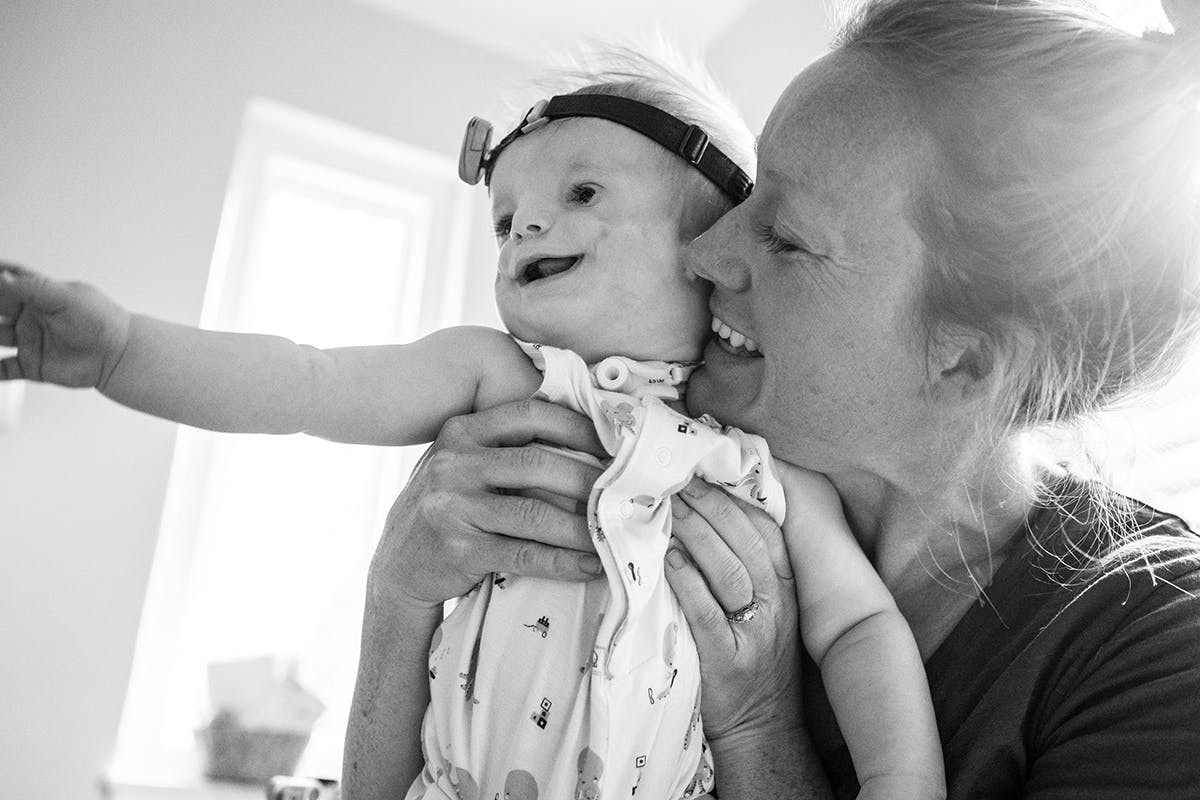 Photograph of young child with Treacher Collins syndrome and mother by documentary photographer Kirsten Lewis