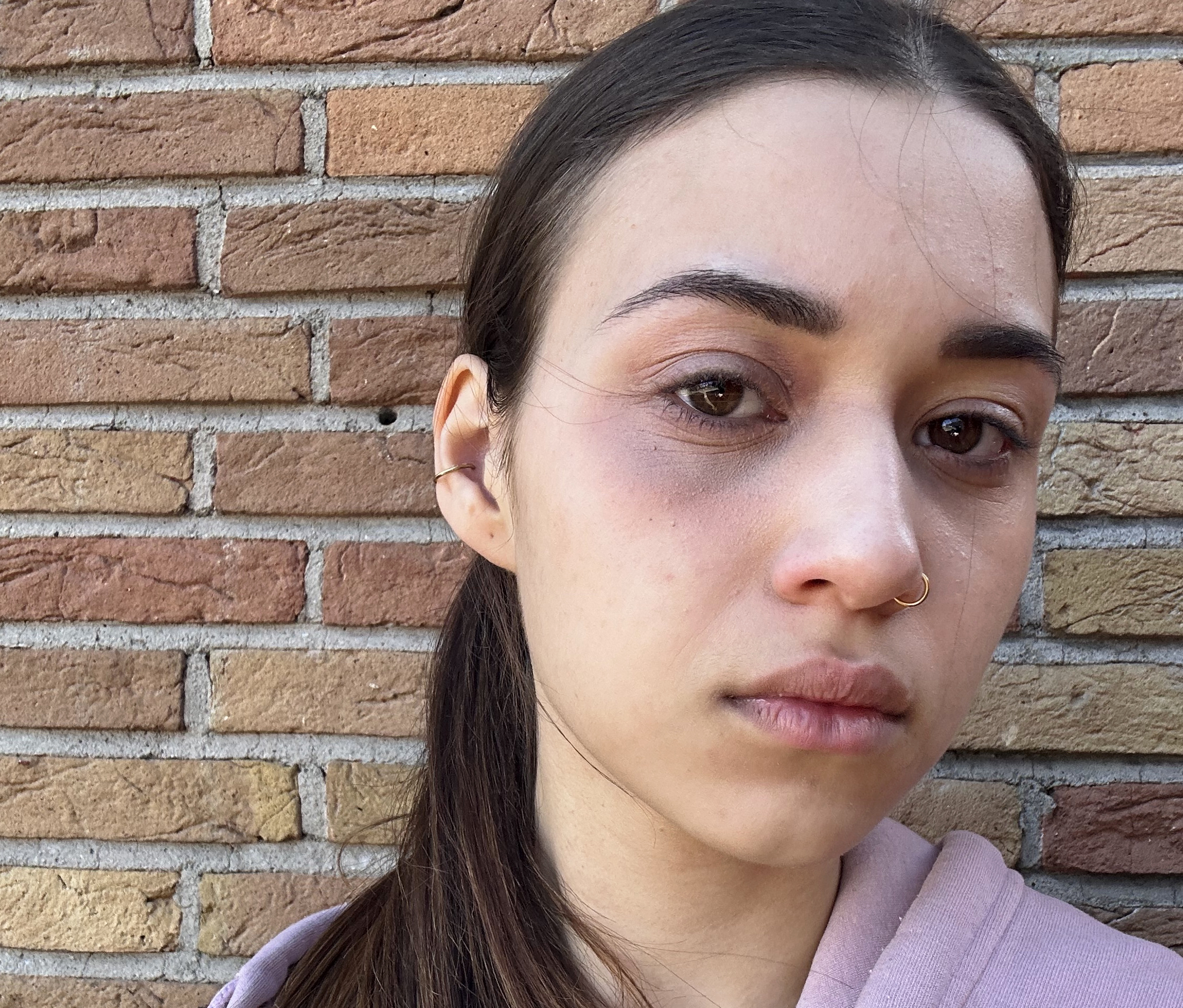 Foto van een meisje met een blauw oog