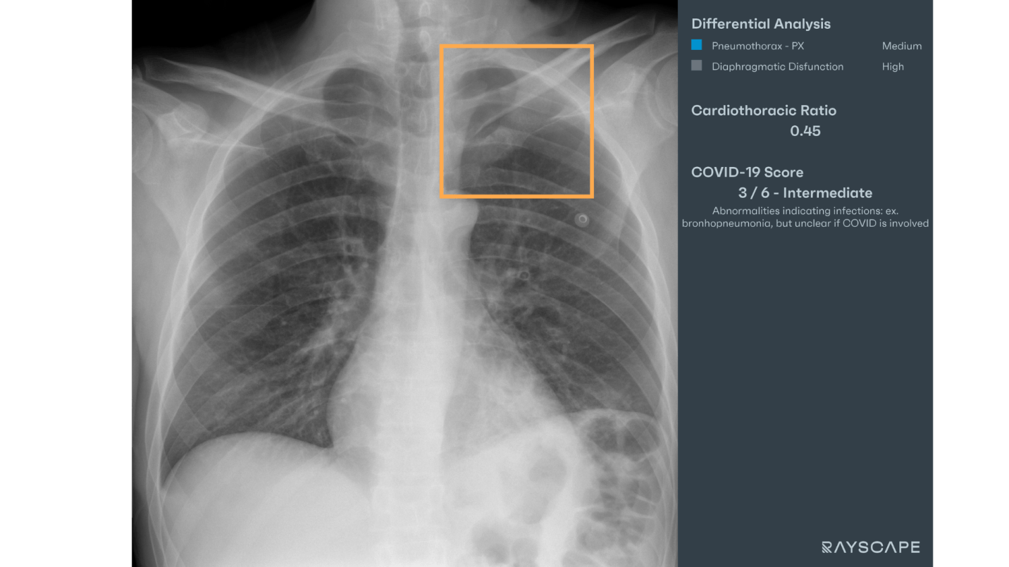 Pneumothorax in a trauma patient