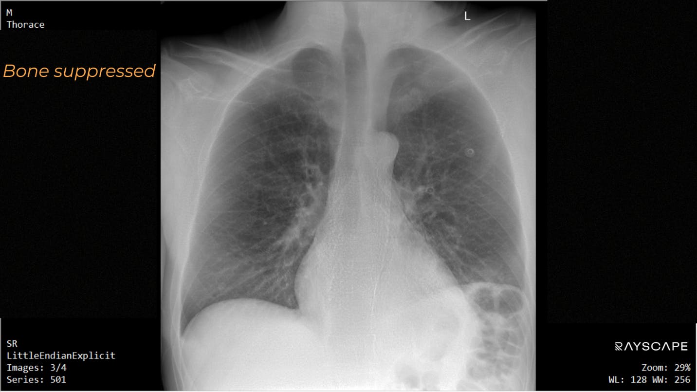 Pneumothorax in a trauma patient