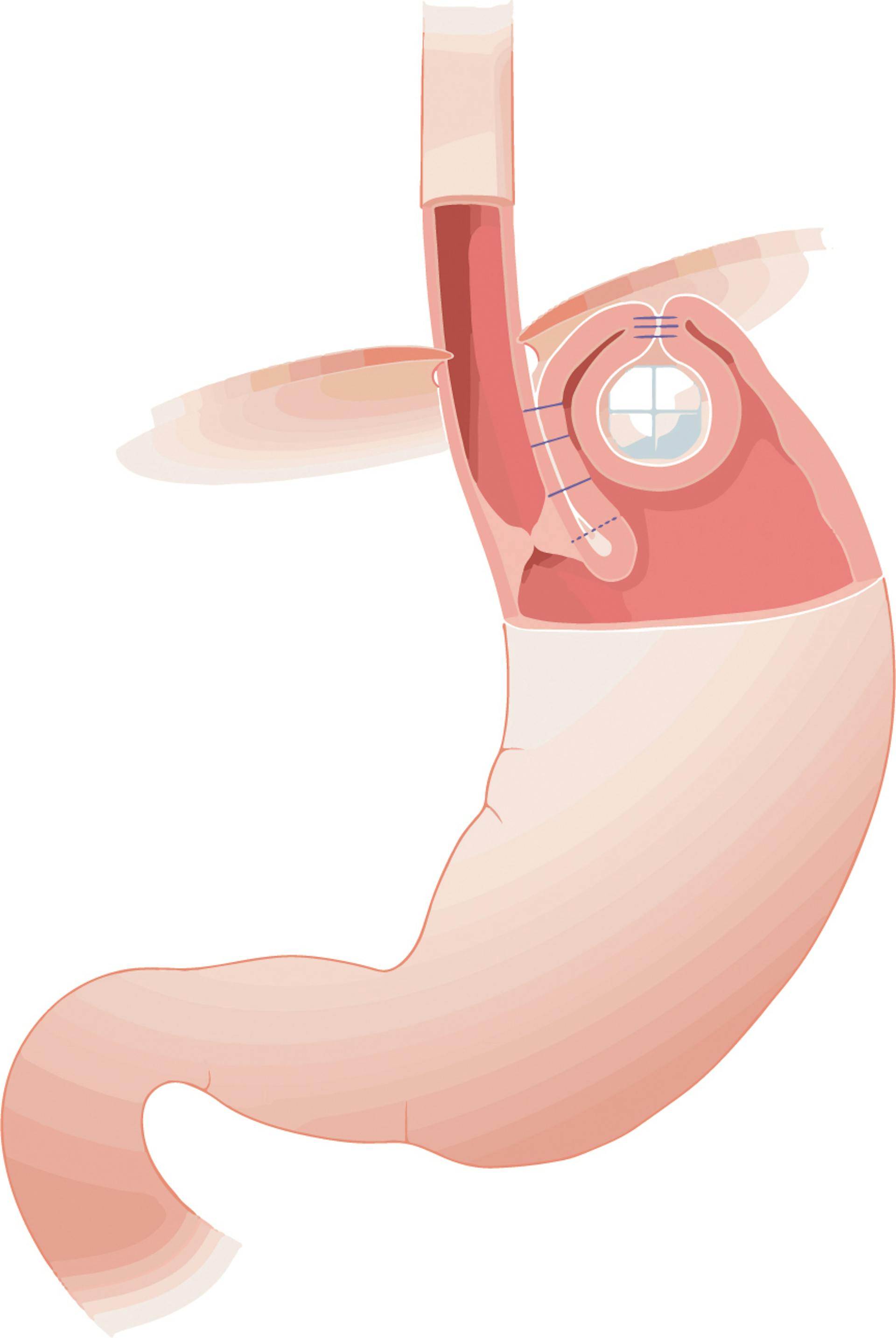 Image of the placement of a RelfuxStop device in the stomach