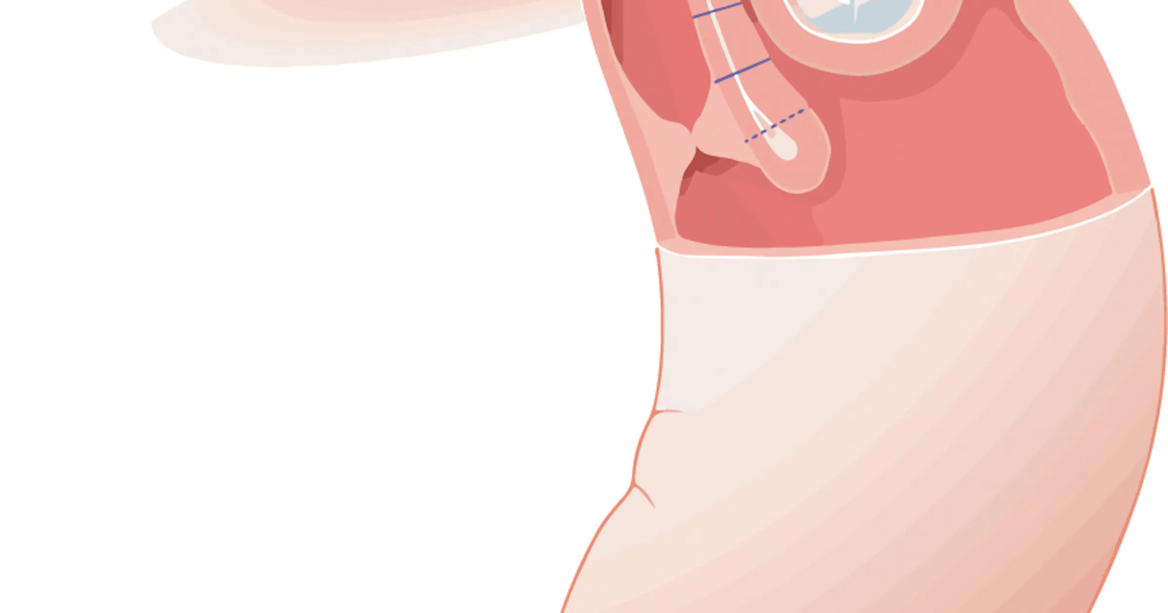 Reflux Stop RefluxStop™ Procedure | RefluxStop Device - RefluxUK