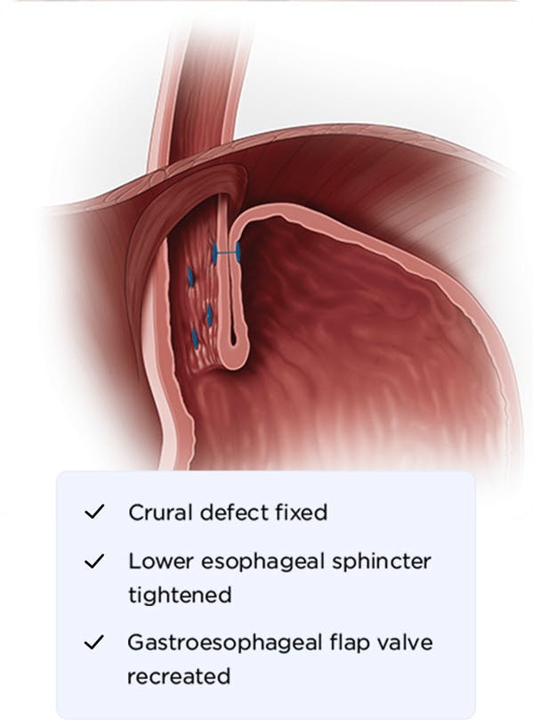 graphic of the crural (hiatus hernia) repair from a ctif, along with the stapling of the TIF procedure