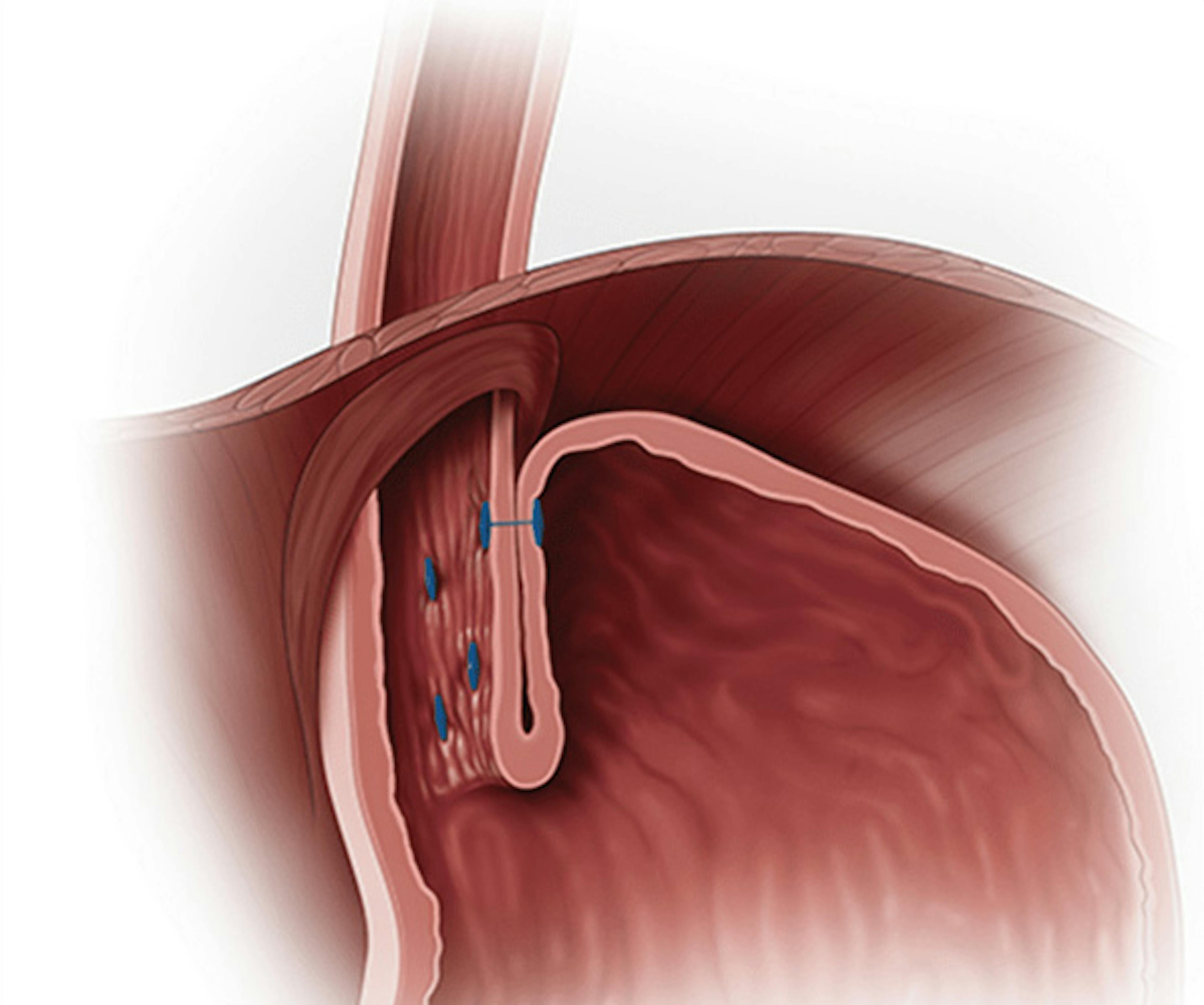 image of the lower oesophageal spincter, stomach and oesophagus after the TIF procedure