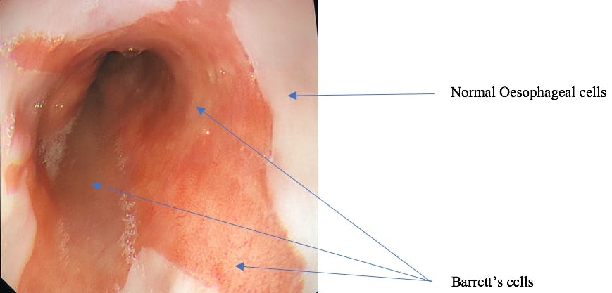 The “salmon” coloured Barrett’s columnar cells can be seen creeping up the oesophagus and replacing the paler normal oesophageal cells. A slightly different pattern of tiny blood vessels under the surface can be discerned.