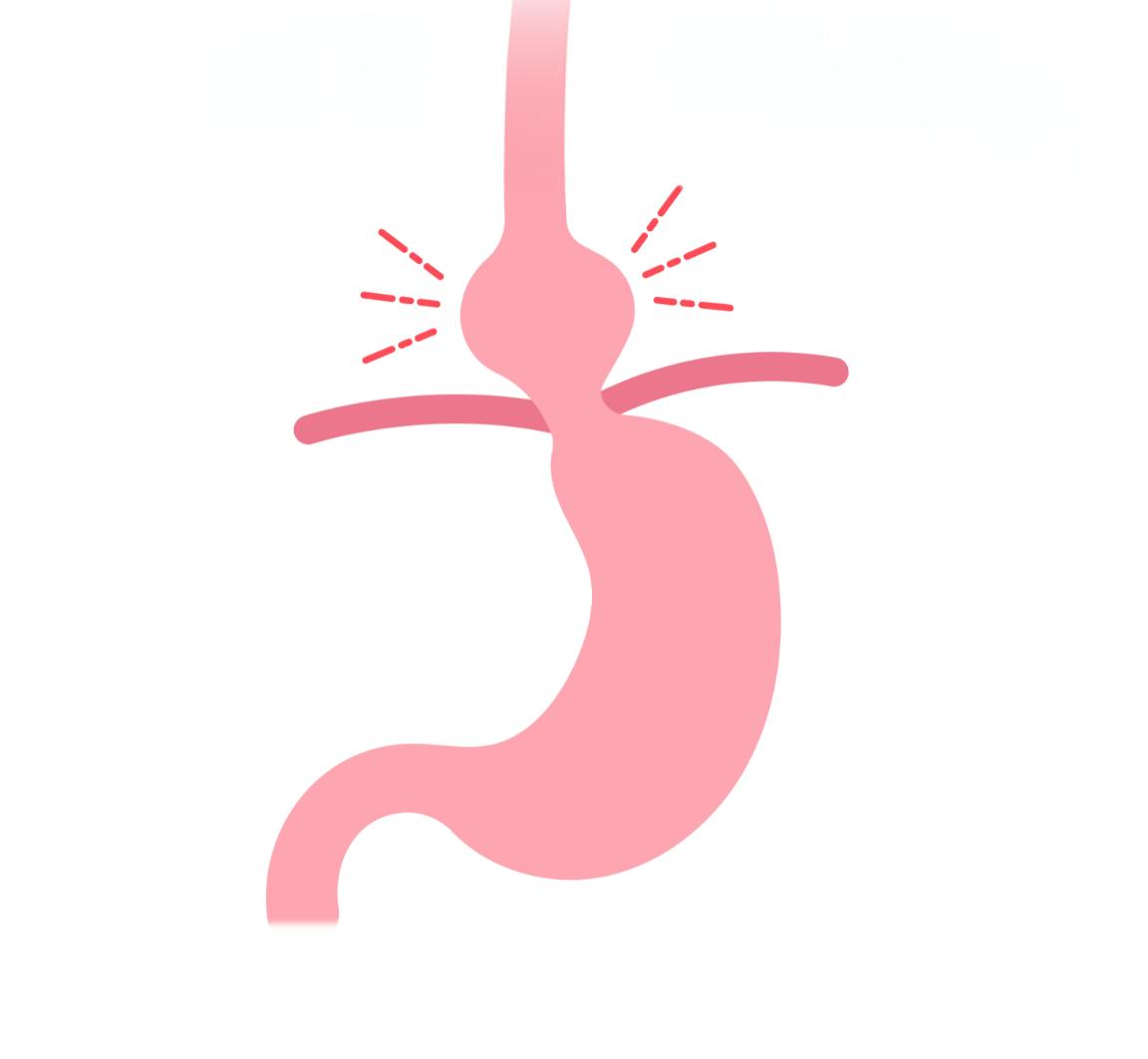 graphic of a hiatus hernia