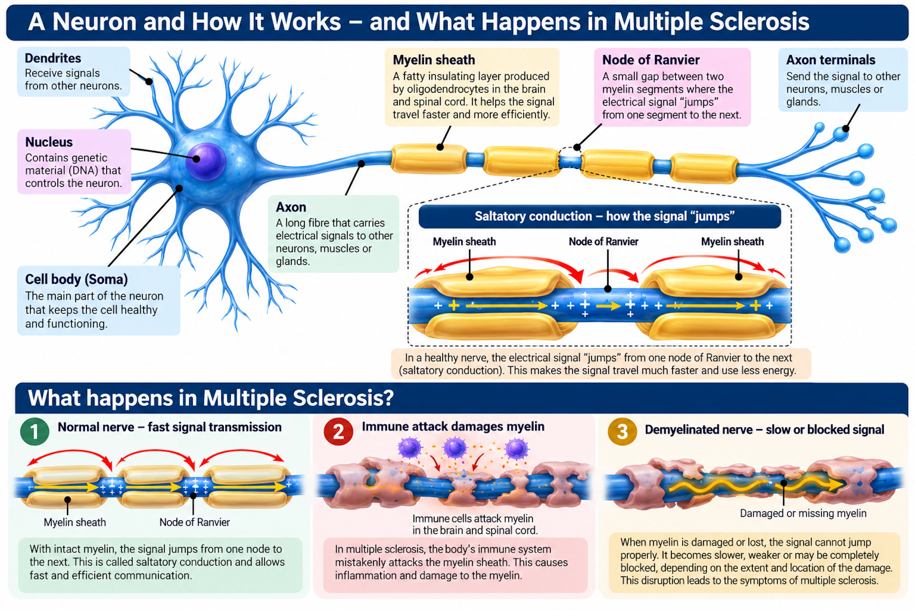 How a nerve signal jumps between nodes of Ranvier, and how immune damage to myelin in multiple sclerosis slows or blocks the signal