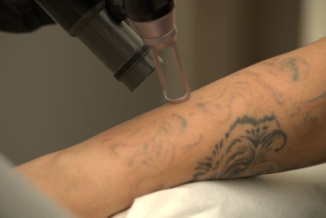 Historien om tatueringsborttagning