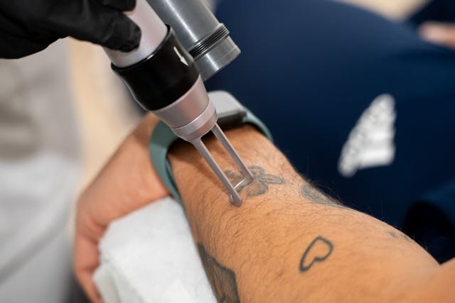 Laserborttagning av tatuering