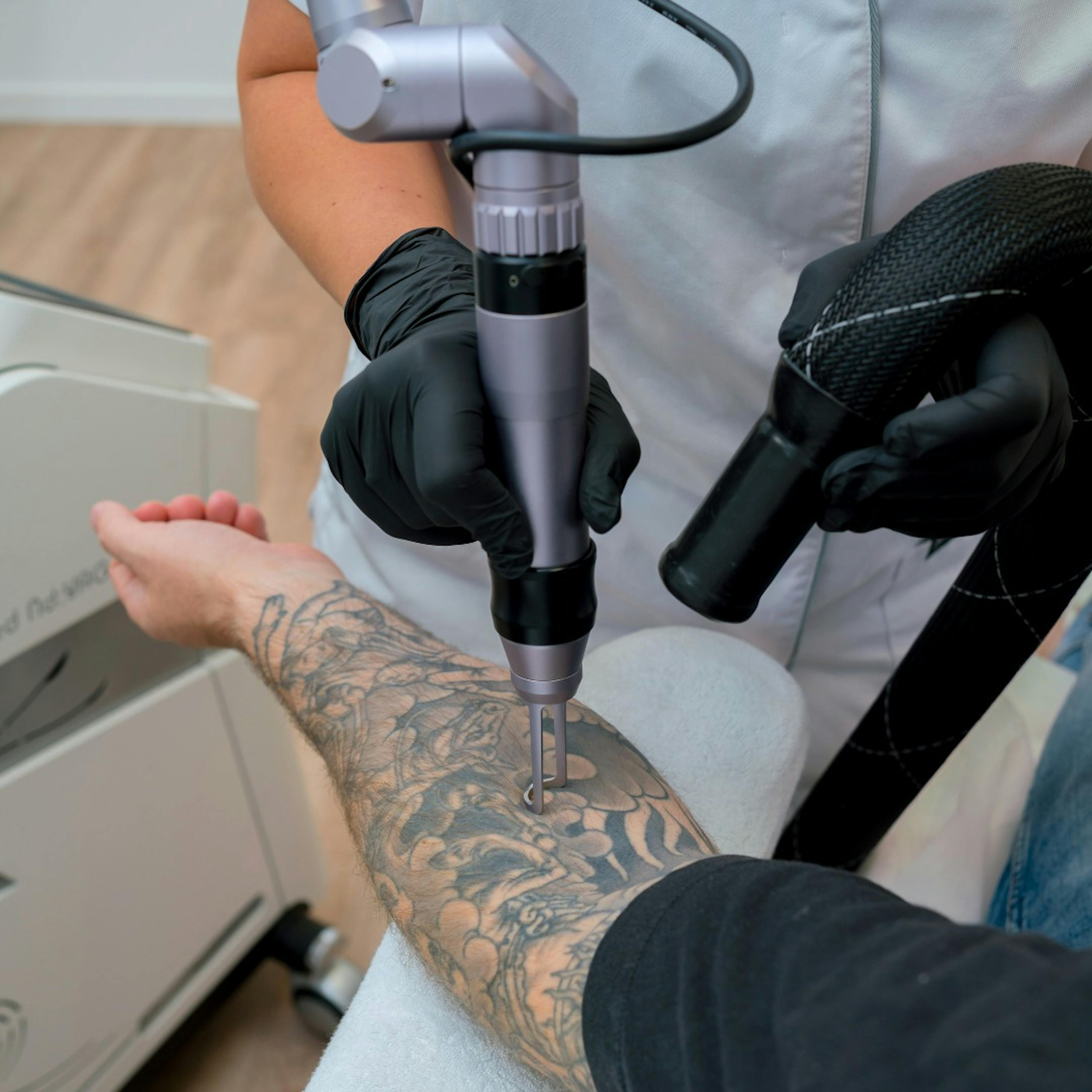 Tatueringsborttagning