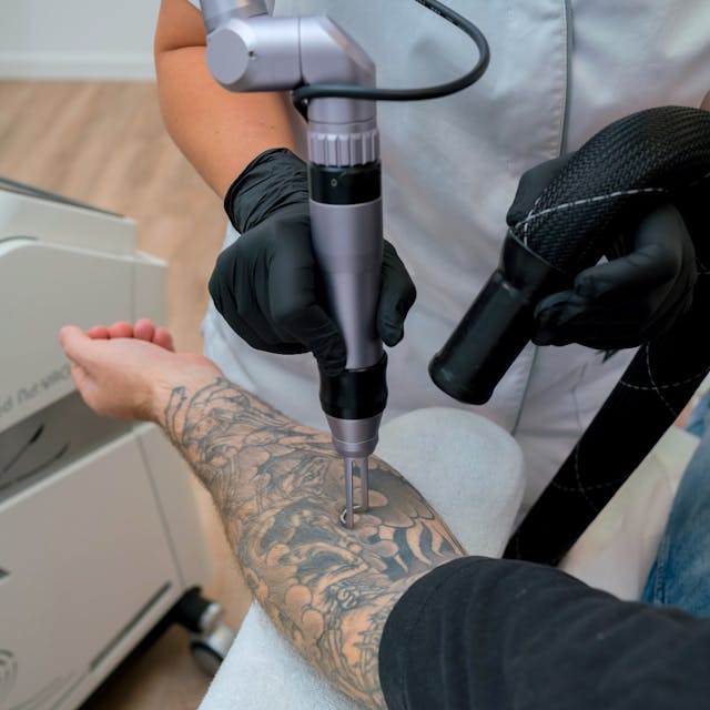 Tatueringsborttagning