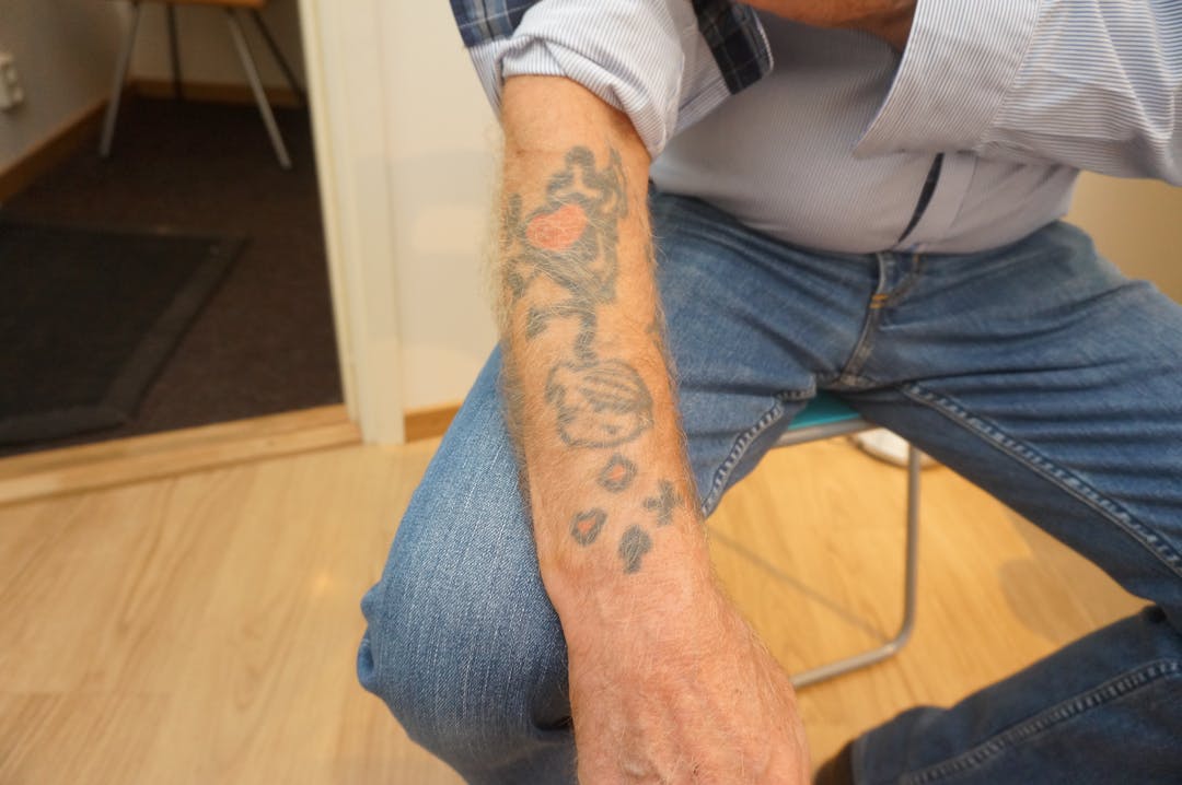 tatuering arm före