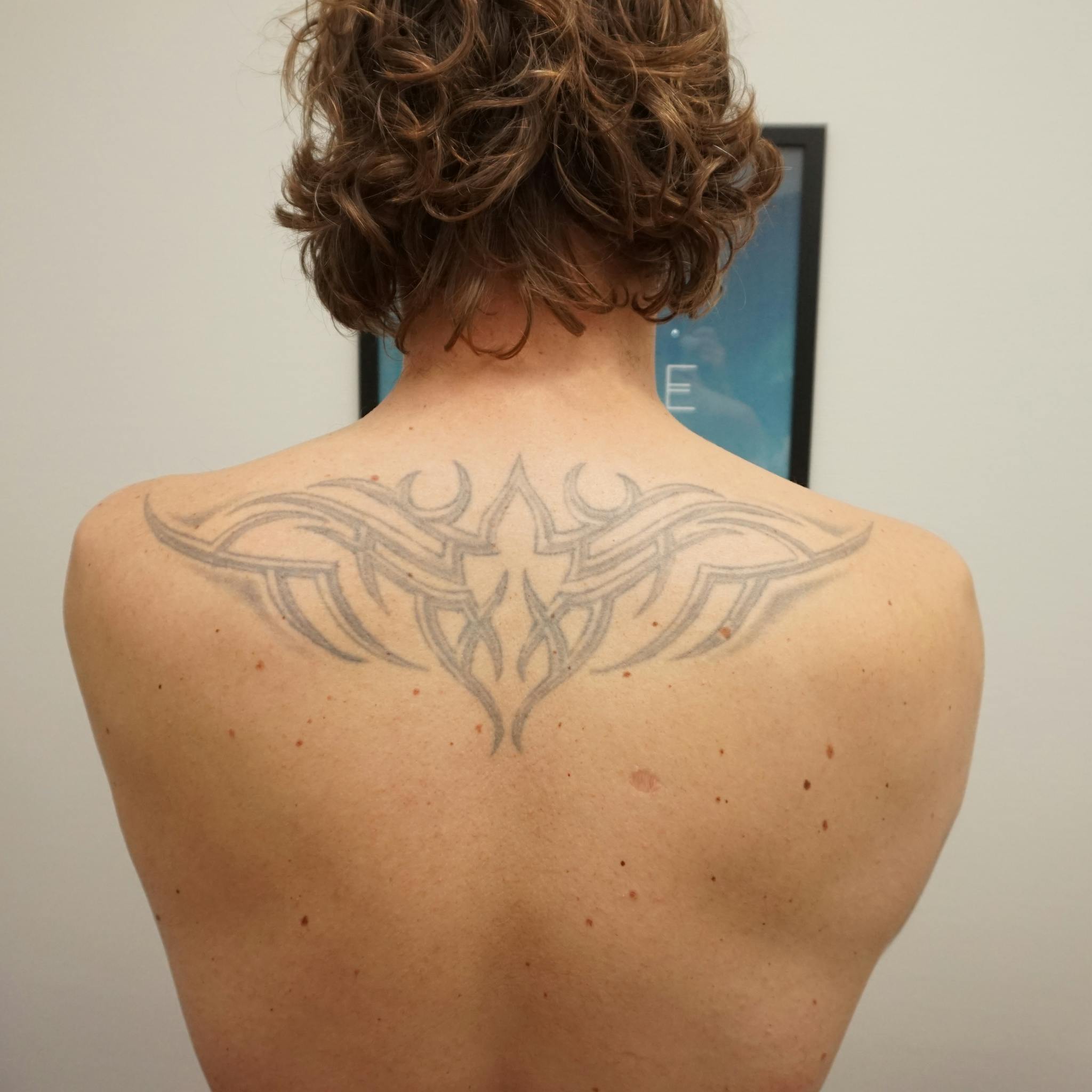 Fjernelse af tatovering påbegyndt