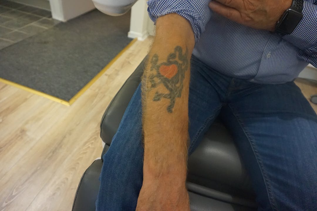 tatuering arm kladdig efter