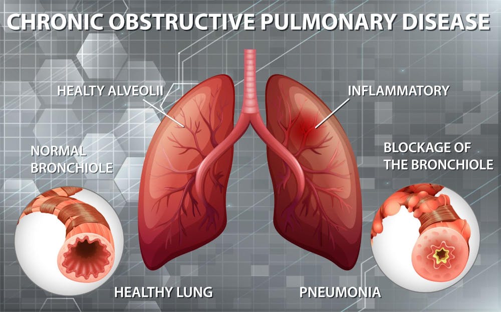 Link between COPD and cold weather