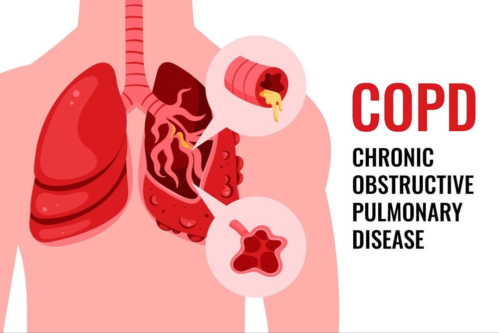 COPD DIET to include and avoid