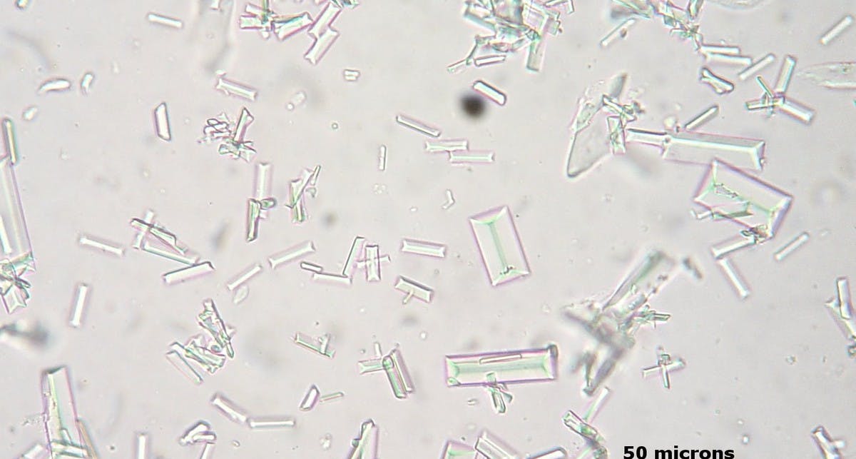 crystals in human urine