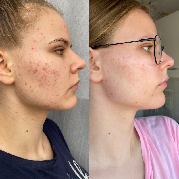 Kobieta z trądzikiem przed i po zastosowaniu kosmetyków