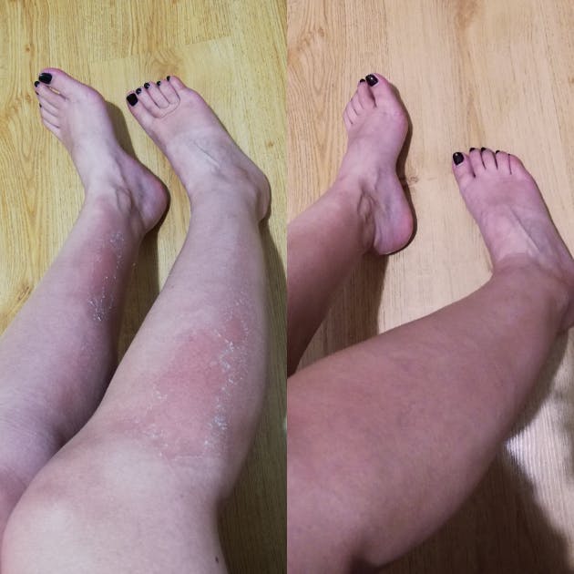 EFFECT BEFORE AND AFTER APPLICATION OF SAMARITE