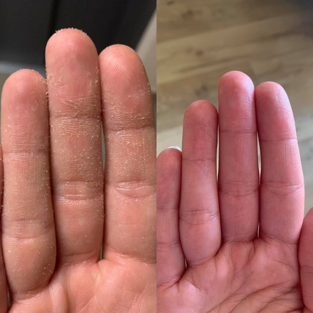 EFFECT BEFORE AND AFTER APPLICATION OF SAMARITE