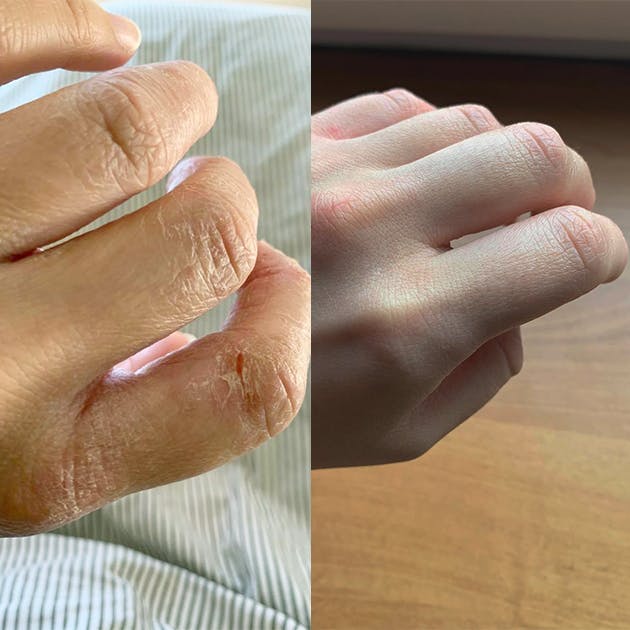 Pękająca skóra na dłoniach