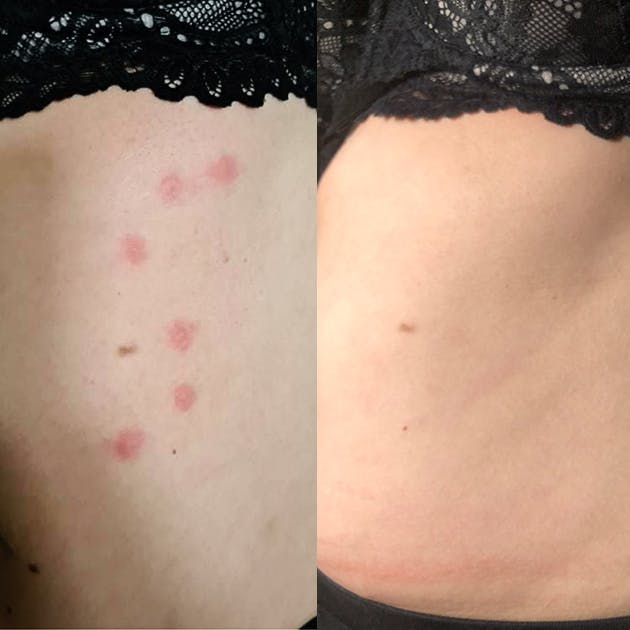 EFFECT BEFORE AND AFTER APPLICATION OF SAMARITE