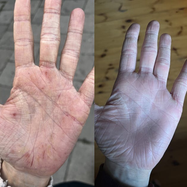Pękająca skóra dłoni