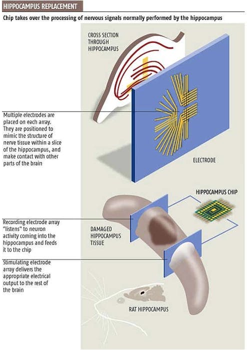 This is a diagram of a hippocampus replacement procedure