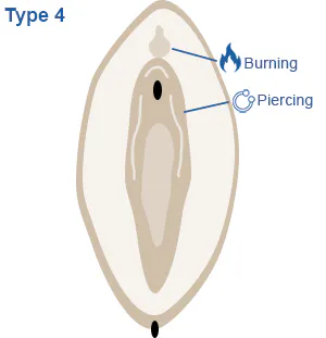 Image of vagina highlighting non-medical procedures to the genitals, such as piercing and burning.