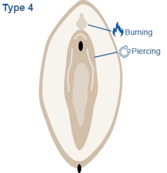 Image of vagina highlighting non-medical procedures to the genitals,  such as piercing and burning.