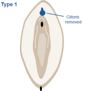 Image of vagina highlighting partial or complete removal of the clitoris and/or clitoral hood