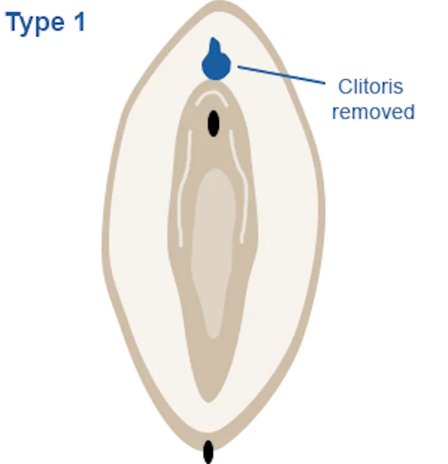 Image of vagina highlighting partial or complete removal  of the clitoris and/or clitoral hood