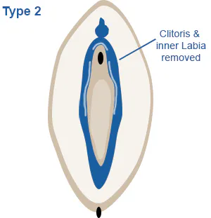 Image of vagina highlighting partial or complete removal of the clitoris and the labia minora (inner lips), with or without the labia majora (thicker skin covered outer lips).
