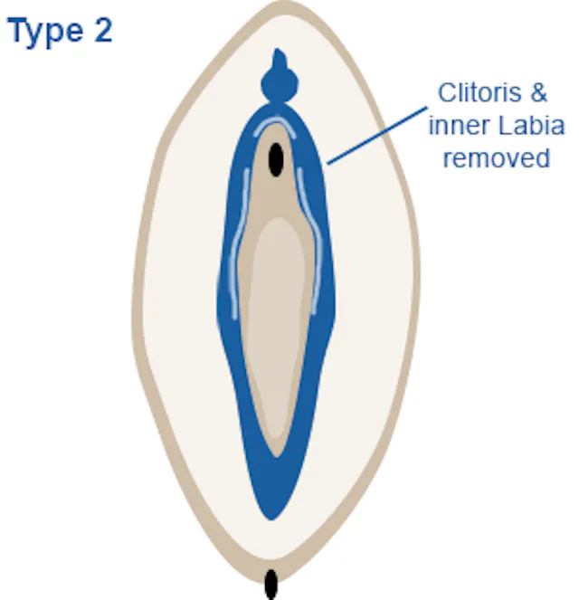 Image of vagina highlighting partial or complete removal of the clitoris and the labia minora (inner lips), with or without the labia majora (thicker skin covered outer lips).