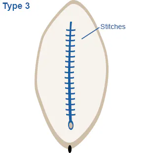 Image of vagina highlighting narrowing of the vaginal opening by creating a seal through stitching, formed by cutting and repositioning and the labia