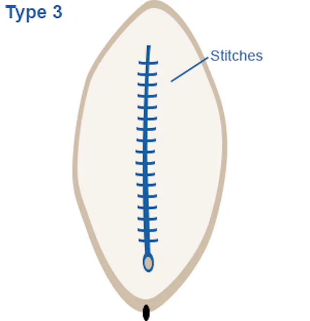 Image of vagina highlighting  narrowing of the vaginal opening by creating a seal through stitching, formed by cutting and repositioning and the labia