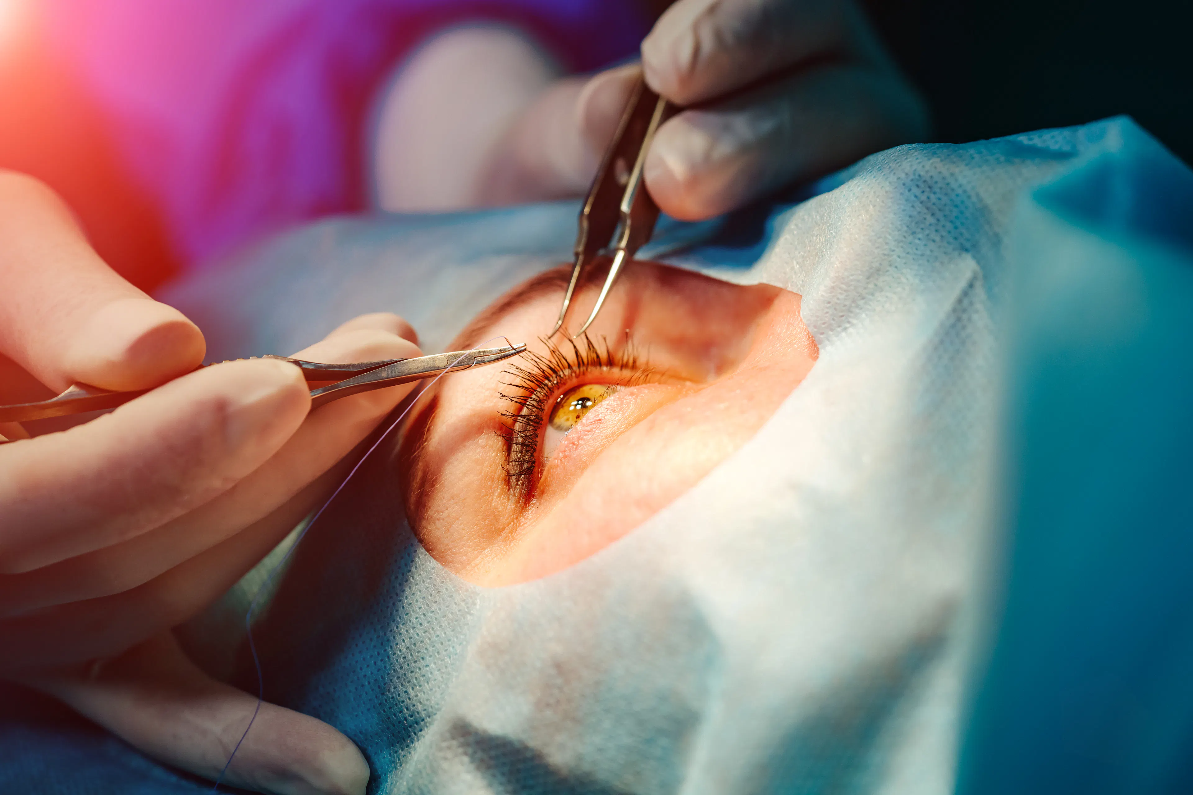 The LASIK Surgery Procedure - What Actually Happens