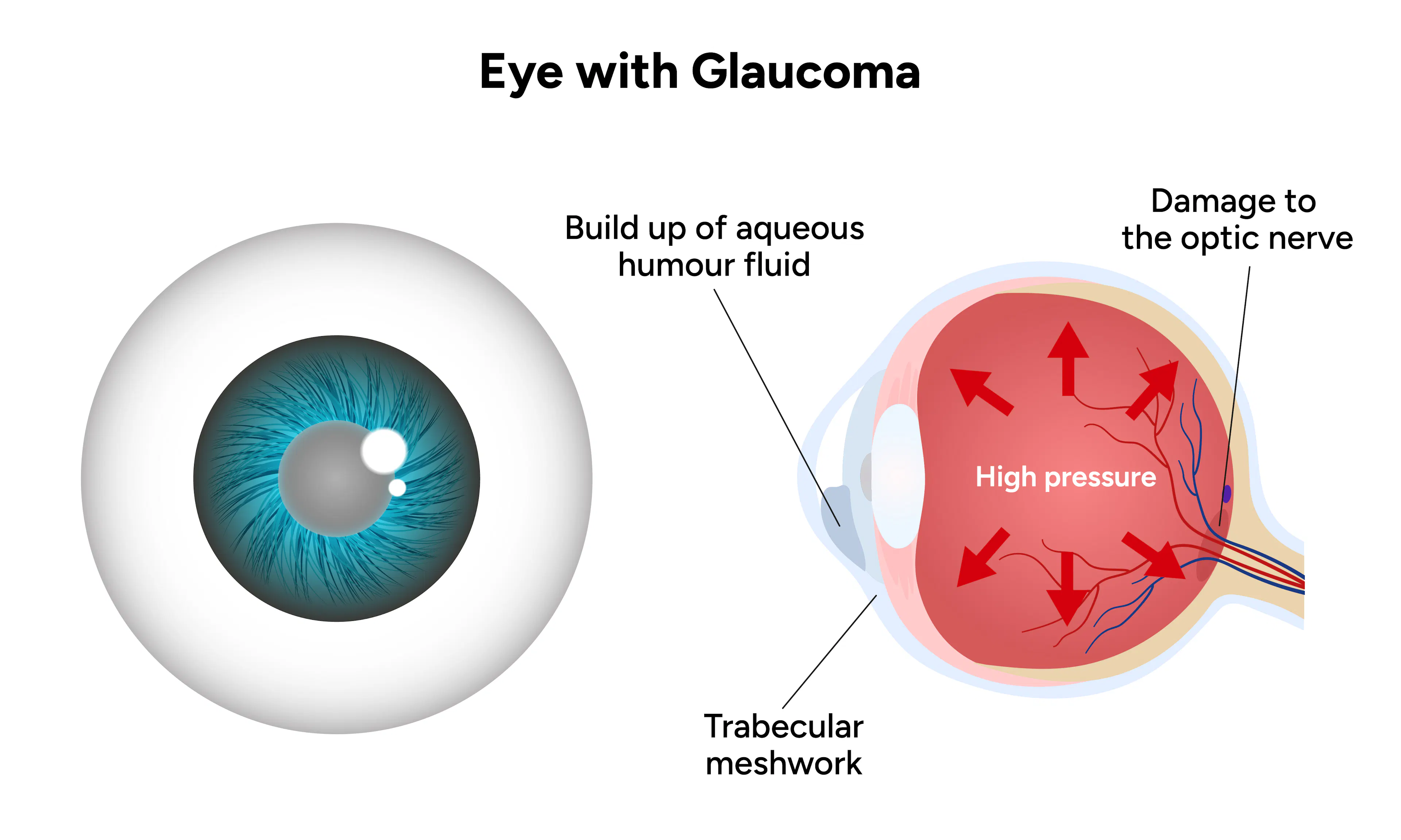 So What Exactly Is Glaucoma?