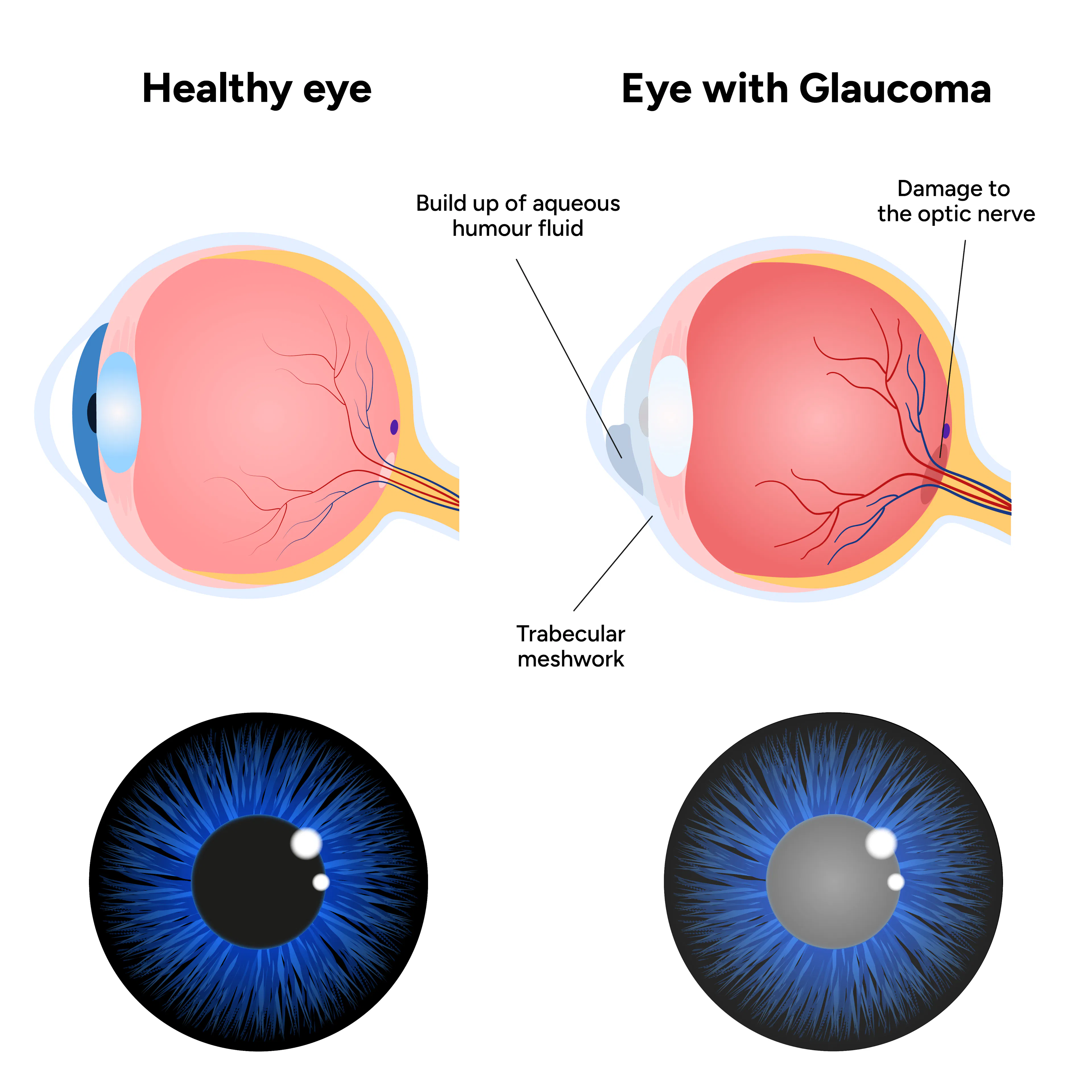 How Glaucoma Occurs