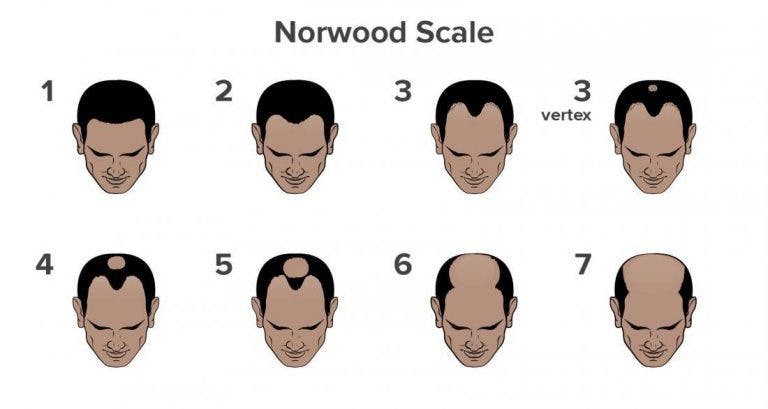 Norwood Scale