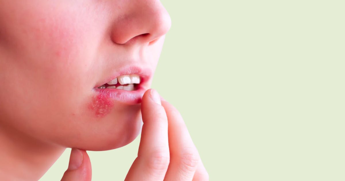 Oral and Genital Herpes: Causes, Symptoms and Treatments in Singapore