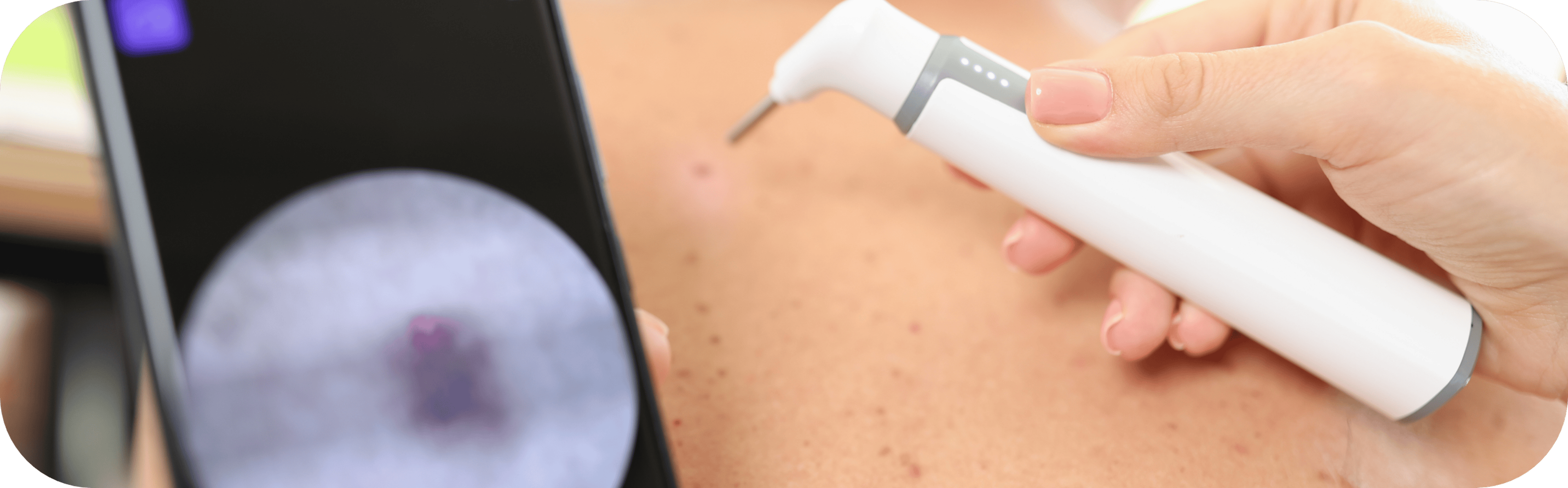 man having his mole scanned